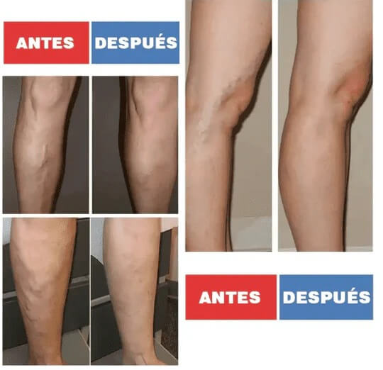 PARCHES PARA EL TRATAMIENTO DE VARICES